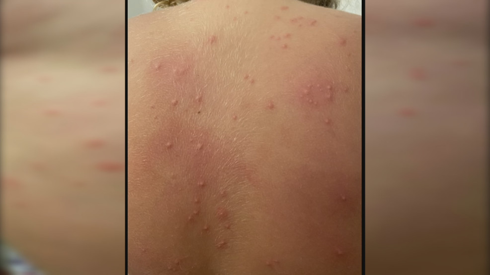 Girl, 6, gets bad rash from Rhode Island ocean - WJAR